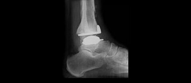 Sprunggelenk Sprunggelenk