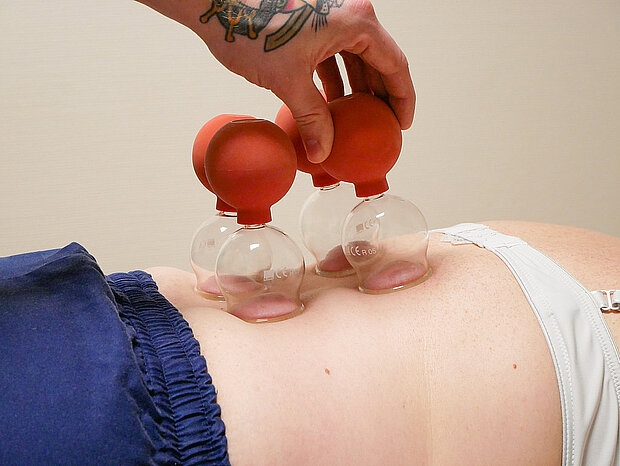 Schröpfen Schröpfen