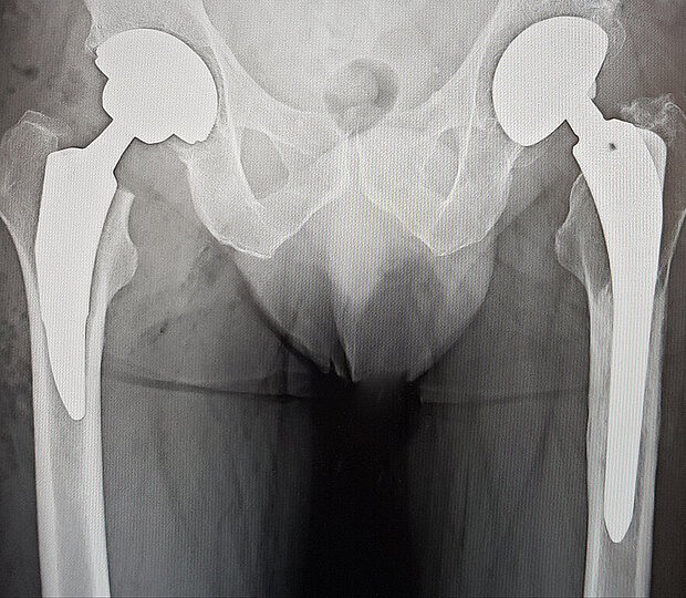 Kurzschaftprothese Kurzschaftprothese