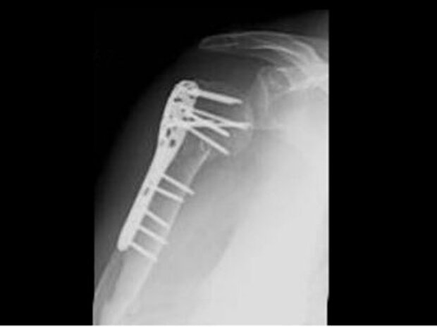 Fixateur intern Fixateur intern